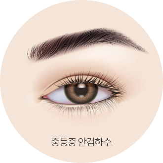 더웰병원 안검하수는 눈매교정술로!